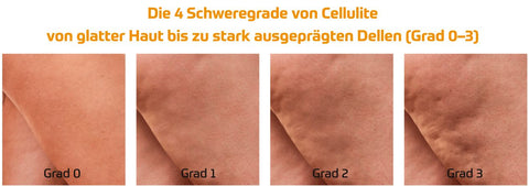 GUAM Algenfango gegen Cellulite zeigt die 4 Schweregrade von Cellulite mit Bildvergleich Grad 0 glatte Haut Grad 1 leichte Dellen sichtbar bei Druck Grad 2 Cellulite sichtbar ohne Druck im Stehen Grad 3 stark ausgeprägte Dellen sichtbar im Stehen und Liegen ideal zur Verdeutlichung der Unterschiede zwischen den Stadien von Orangenhaut für Anti Cellulite Behandlung Hautstraffung und Mikrozirkulationsförderung. Naturpräparate Dieterich