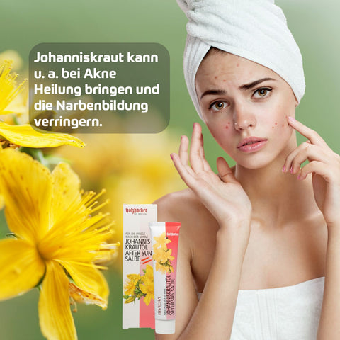 Holzhacker Johanniskrautöl After Sun Salbe 75 ml in Tube mit Umkarton. Foto von Frau mit Pickeln im Gesicht  und Text: Johanniskraut kann u.a. bei Akne Heilung bringen und die Narbenbildung verringern.| Naturpräparate Dieterich